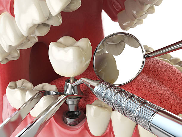 Best Emergency Broken Tooth Repair in Lyons, OR